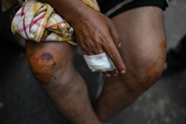 Injuries sustained by a protester are seen during a demonstration led by the CJP campaign at Jantar Mantar on July 21, 2026, in New Delhi, India.